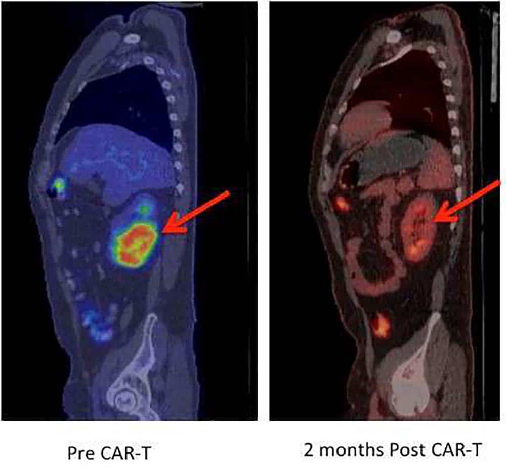 The Possibilities and Risks of Genetically Altering Immune Cells to Fight Cancer