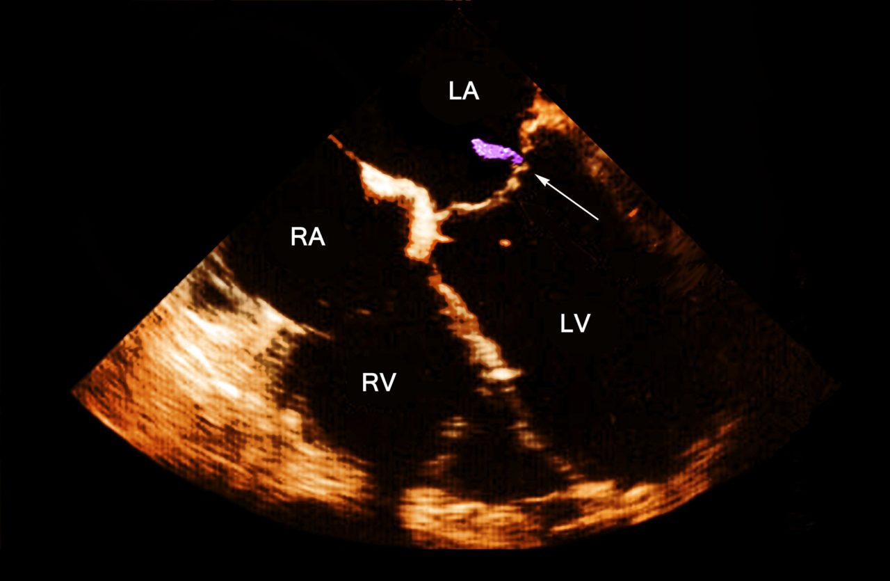 Drug Abuse-Related Infective Endocarditis Rising at Alarming Rate